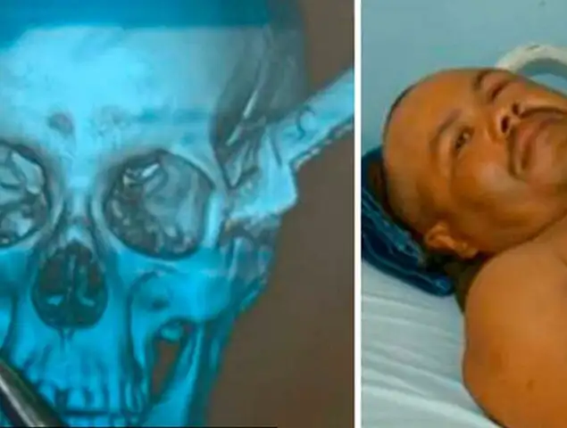 Brasil: Un hombre viajó 100 kilómetros con un cuchillo clavado en la cabeza