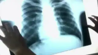 Hospital de Huaycán usa insumos vencidos para rayos X