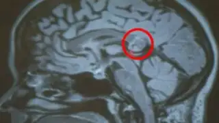 EEUU : mujer tenía el embrión de su gemela en el cerebro