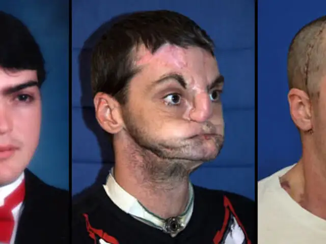FOTOS : los 10 trasplantes de cara más asombrosos