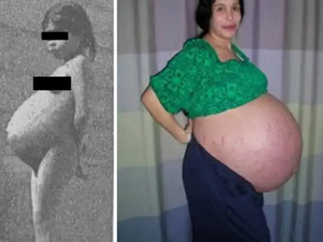 FOTOS : los 10 casos de embarazos más sorprendentes y extraños
