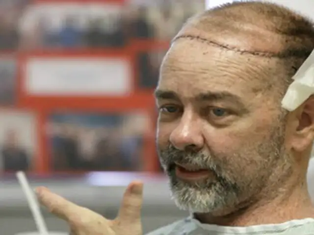 EEUU : primer trasplante de cráneo y cuero cabelludo fue un éxito