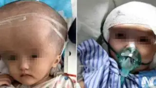 Menor de tres años recibe trasplante completo de cráneo impreso en 3D
