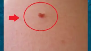 YouTube: una mujer decidió quitarse un lunar de carne y quedó de esta manera