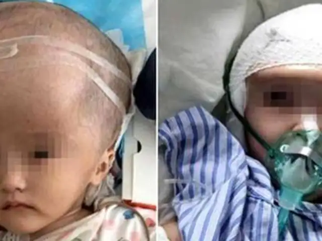 Menor de tres años recibe trasplante completo de cráneo impreso en 3D