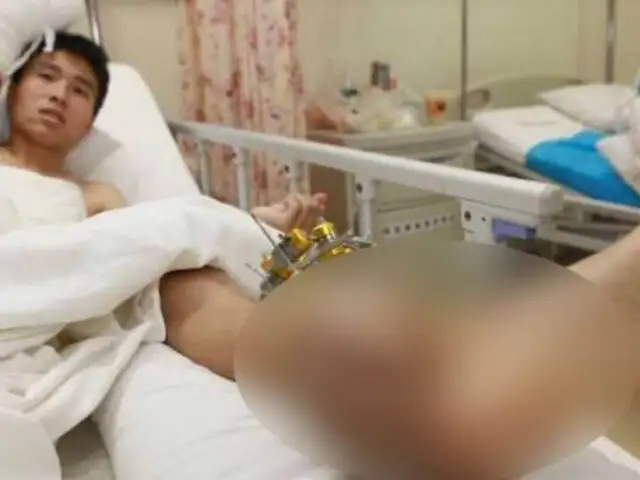 FOTOS: médicos salvan la mano de un hombre implantándosela en la pierna