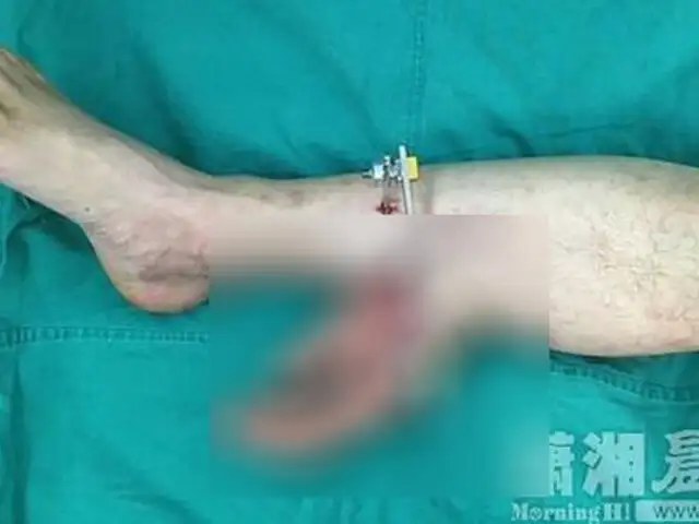Médicos implantan mano en la pierna de un obrero para mantenerlo 'vivo'