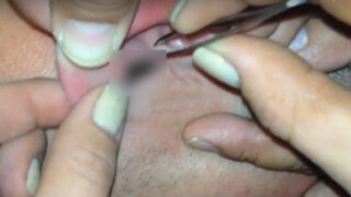 China: médicos hallan 26 cucarachas en oído de hombre