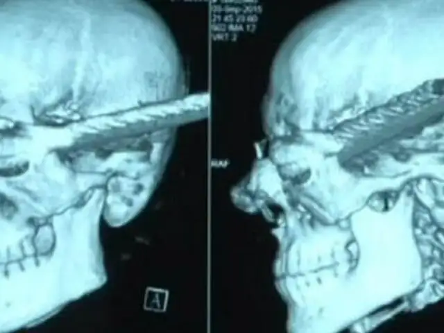 VIDEO: barra de acero atraviesa cabeza de obrero y este sobrevive