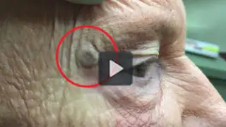 VIDEO: espinilla gigante fue removida del rostro de una anciana
