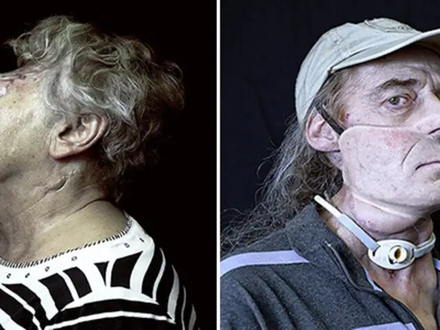 FOTOS: impactantes retratos de personas que fueron desfiguradas
