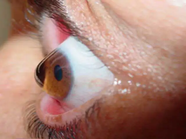 Doctor en Familia: ¿Qué es el queratocono y cómo afecta a la vista?