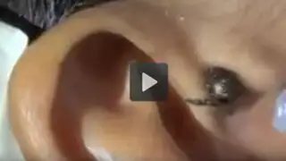 VIDEO: terroríficas imágenes de una araña saliendo del oído de una persona