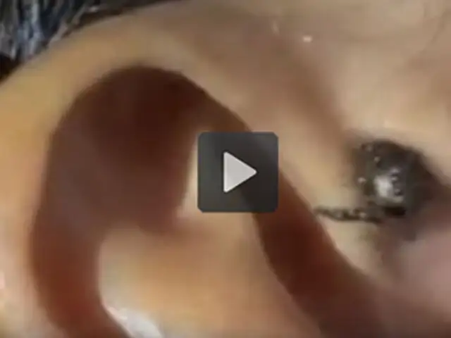 VIDEO: terroríficas imágenes de una araña saliendo del oído de una persona