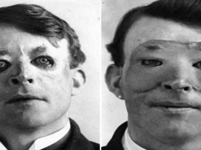 FOTOS: estos fueron los primeros casos de impresionantes cirugías reconstructivas