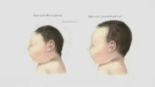 EEUU: nace bebé con microcefalia asociada al Zika