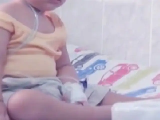 Niño tarapotino que sufría de obstrucción respiratoria fue operado en Lima