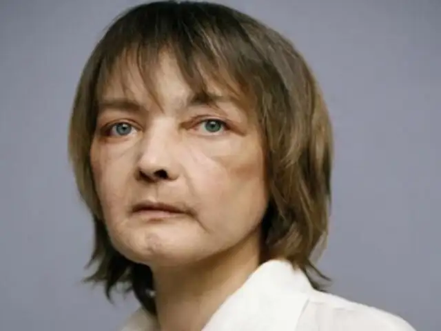 Francia: muere primera paciente de trasplante de rostro