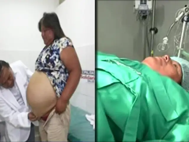 Mujer será operada por hernia gigante en Hospital de la Solidaridad de San Borja