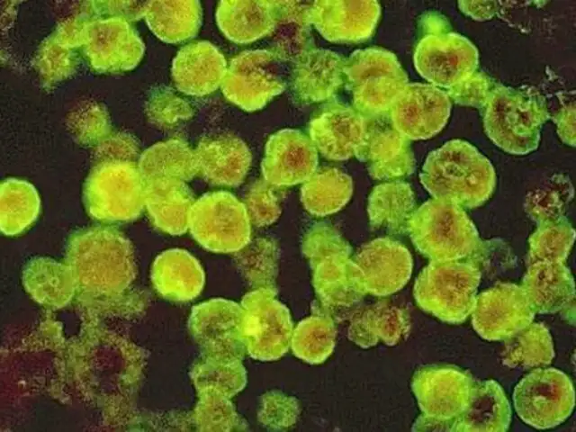 ‘Ameba come cerebros’: un parásito mortal que ya mató a 5 adolescentes