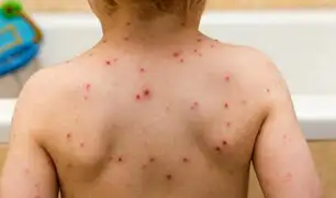 Comas: bebé muere por no recibir vacuna contra la varicela