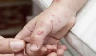 Chimbote: reportan muerte de menor de 1 año por virus de la varicela
