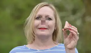 Reino Unido: prótesis magnética le cambió la vida a una mujer sin nariz