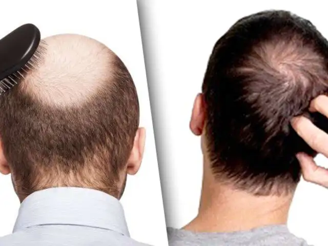 ¿El COVID-19 también puede ocasionar la caída del cabello?