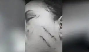Los Olivos: joven quedó desfigurada tras ser agredida en una discoteca