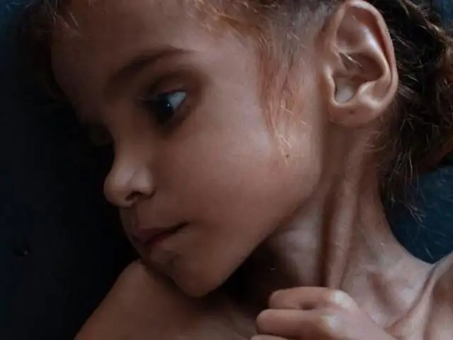 Amal Hussain: falleció la niña símbolo de la hambruna en Yemen