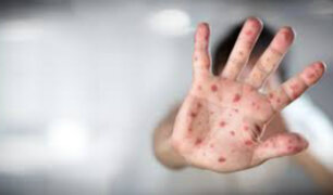 Declaran emergencia sanitaria en Washington por brote de sarampión