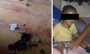 San Martín: celular explota y niño de 2 años casi pierde el ojo
