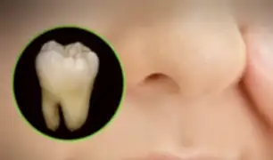 Insólito: hombre descubre que tenía un diente creciendo en la nariz [FOTOS]
