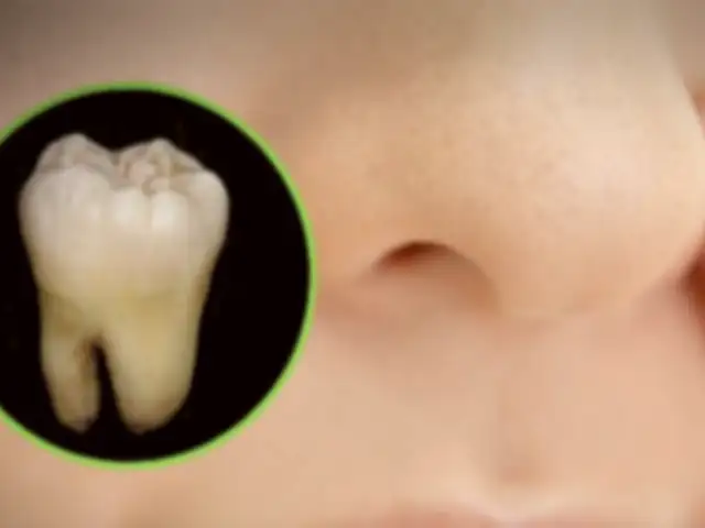 Insólito: hombre descubre que tenía un diente creciendo en la nariz [FOTOS]