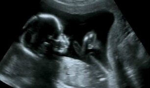 Insólito: bebé nace ''embarazada'' de su hermano mellizo