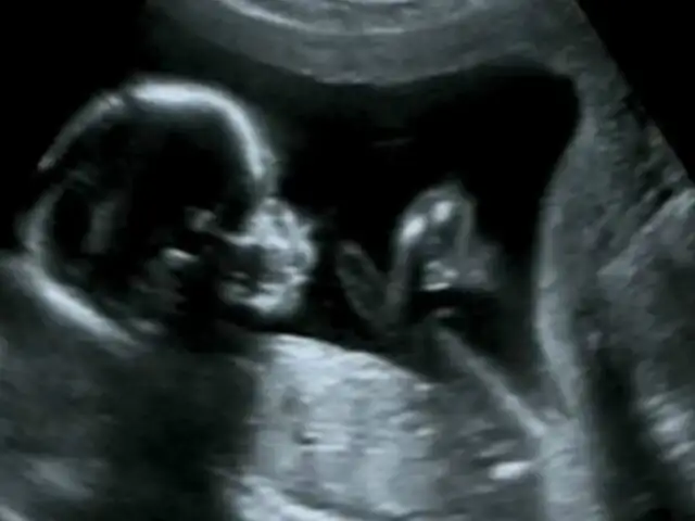 Insólito: bebé nace ''embarazada'' de su hermano mellizo