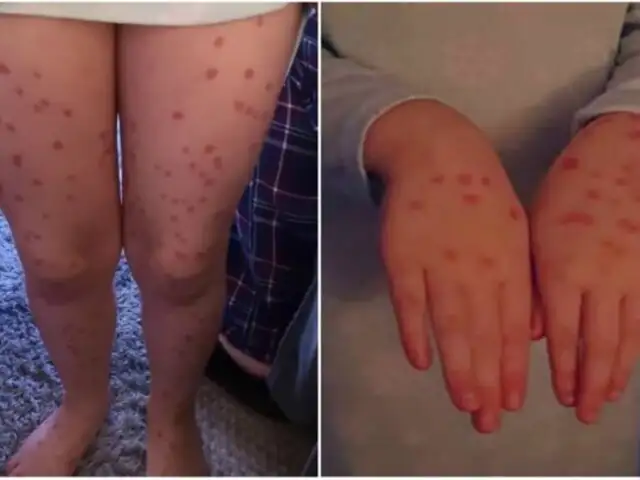 Niña se dibujó puntos rojos en el cuerpo para fingir varicela y no asistir a escuela