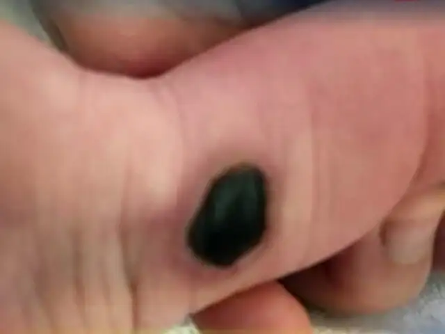 Padre denuncia que quemaron pie de su bebé en clínica El Golf