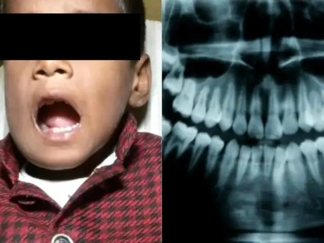 India: extraen más de 500 dientes a niño de siete años