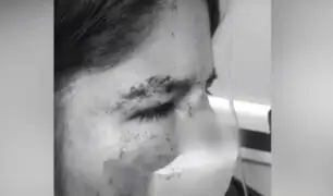 Santa Anita: sujeto arranca parte de la nariz a su pareja de una mordida