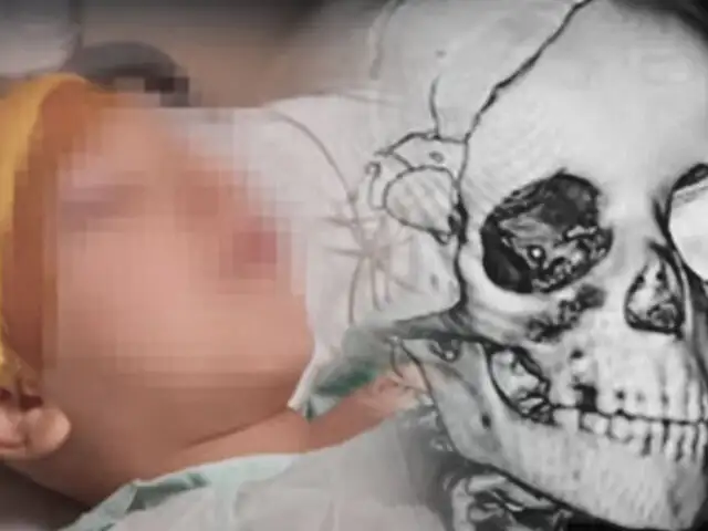 Operan a niño que cayó en rieles del Metro de Lima y su estado es delicado