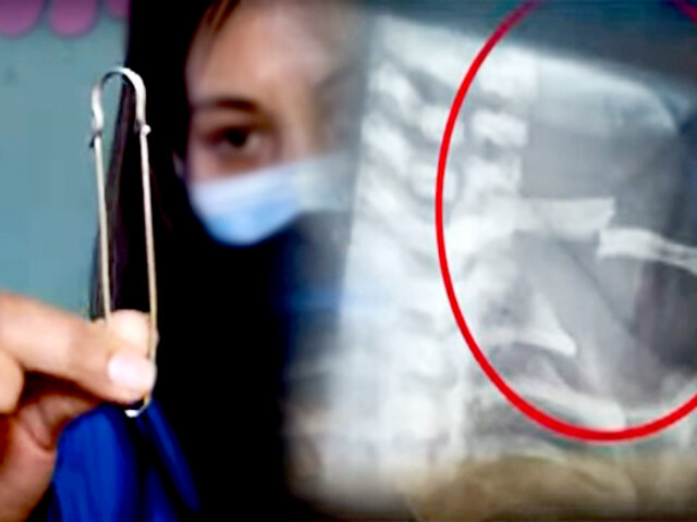 Hospital Cayetano: médicos sugieren un imperdible para tratar fractura de clavícula de bebé
