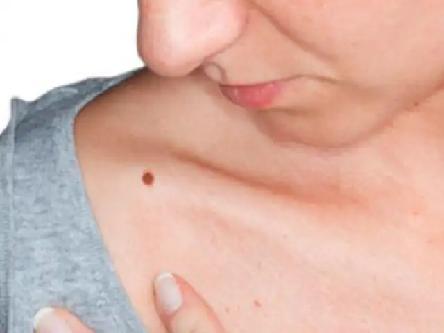 Cada año en el Perú se diagnostican 1 300 nuevos casos de cáncer de piel tipo melanoma
