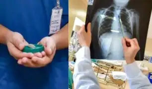 Médicos del Hospital del Niño operan a menor que tenía una piedra incrustada en el esófago