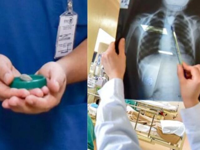 Médicos del Hospital del Niño operan a menor que tenía una piedra incrustada en el esófago