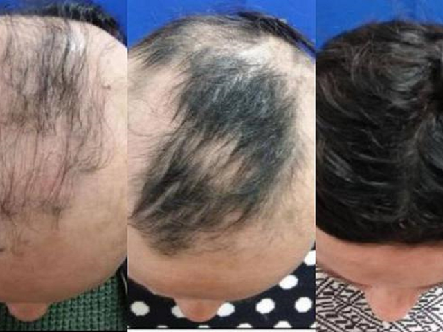 Píldora experimental contra alopecia logra que 40% de pacientes recuperen cabello