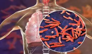 ¡Atención! Minsa detectó alto riesgo de tuberculosis en 12 regiones del Perú
