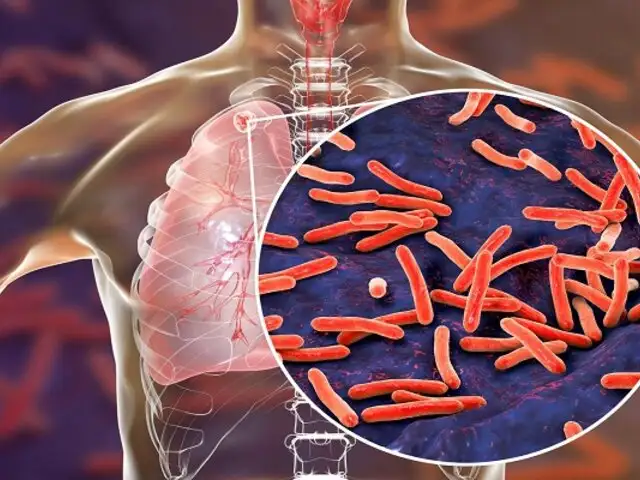 ¡Atención! Minsa detectó alto riesgo de tuberculosis en 12 regiones del Perú