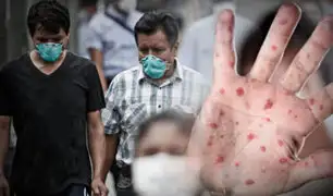 Viruela del mono: número de contagios sube a 36 y compromete a distritos de Lima y el Callao