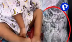 ¡increíble! niño de 2 años tenía ocho agujas en su estómago en Tarapoto